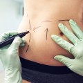 Is Non-Invasive Ultrashape Right for My Body Sculpting Needs?