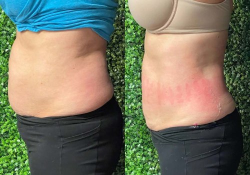 Unleashing the Power of SculpSure: A Non-Invasive Solution for Body Contouring